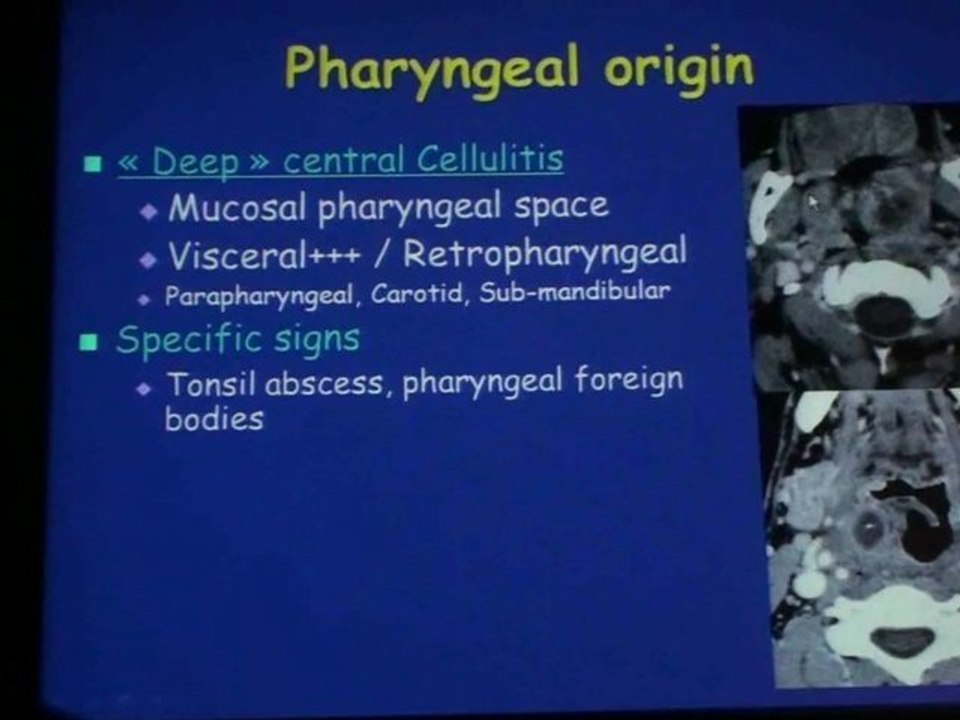 HALIMI Imaging of Cervico-Facial Infections