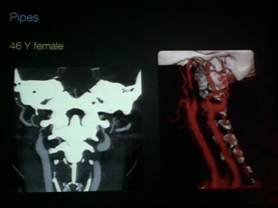 JONAS-KIMCHI Acute Stroke