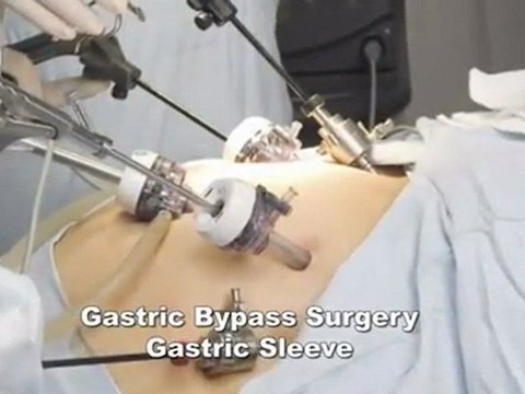 Weight Loss Surgery Houston | Obesity & Bariatric Surgery Houston, Texas