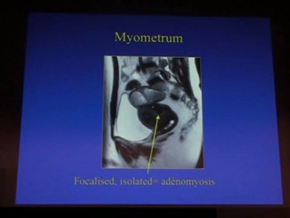 MILLISCHER IMAGING OF ENDOMETRIOSIS 2011