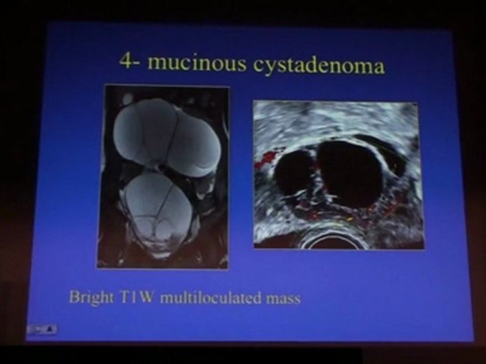 MILLISCHER Sonographically indeterminate adrenal mass 2011