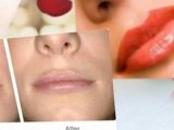 Lip Enhancement Surgery With Dr. Troell