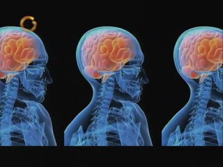 Gracias a la tecnología tratar un tumor cerebral con cirugía tiene pocos efectos secundarios
