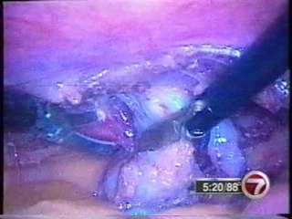 Krongrad Archive 2000 laparoscopic prostatectomy