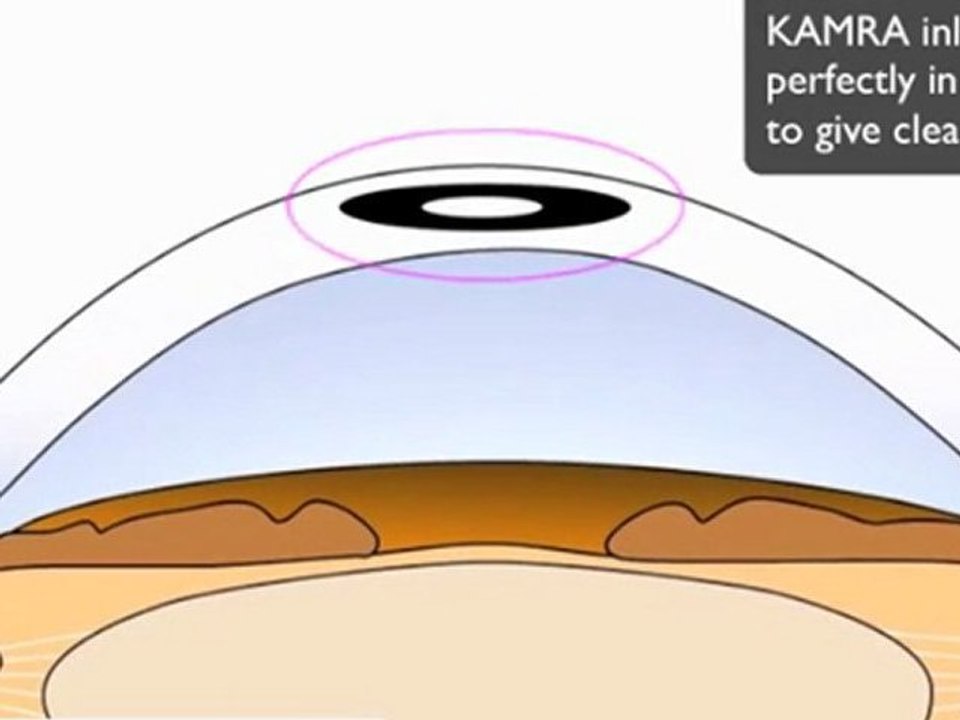 Kamra Inlay UK Pocket Procedure Side View