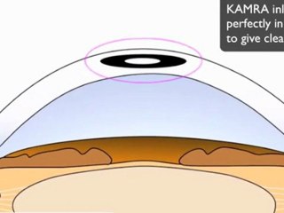 Kamra Inlay UK Pocket Procedure Side View