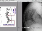 Cifosis juvenil o Enfermedad de Scheuermann. Signos ...