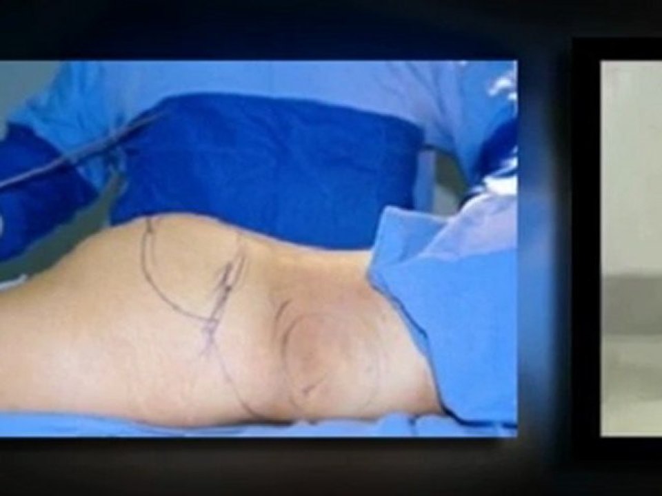 How Safe is Liposuction?
