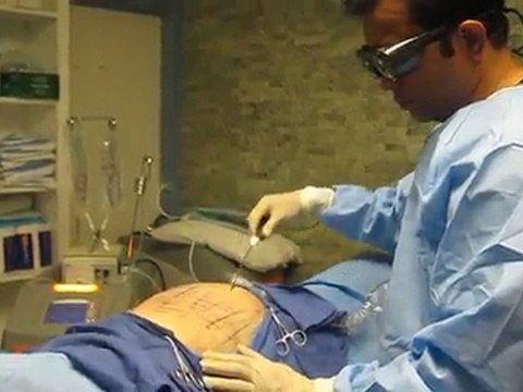 SmartLipo Laser Liposuction- Los Angeles County-Orange County-Riverside County-San Bernardino County-Inland Empire-Anaheim-Fullerton-Beverly Hills-Pasadena-Burbank-Hollywood-Cerritos-Long Beach-Irvine-Costa Mesa-Orange-Brea-Whittier-Pomona-Chino-Fontana