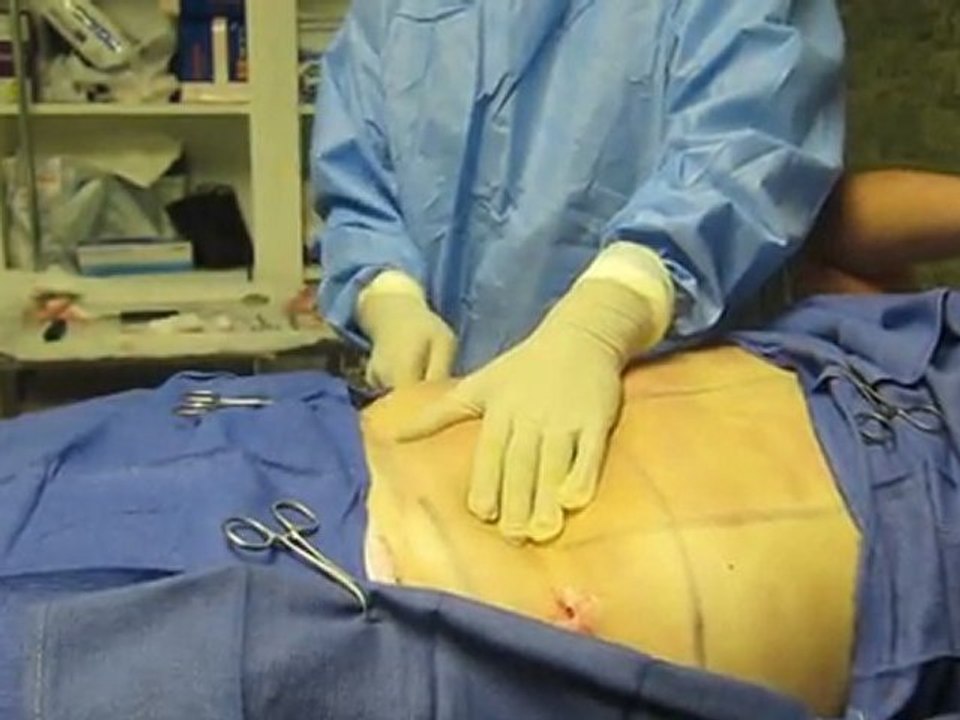 SmartLipo Laser Liposuction- Los Angeles County-Orange County-Riverside County-San Bernardino County-Inland Empire-Anaheim-Fullerton-Beverly Hills-Pasadena-Burbank-Hollywood-Cerritos-Long Beach-Irvine-Costa Mesa-Orange-Brea-Whittier-Pomona-Chino-Fontana