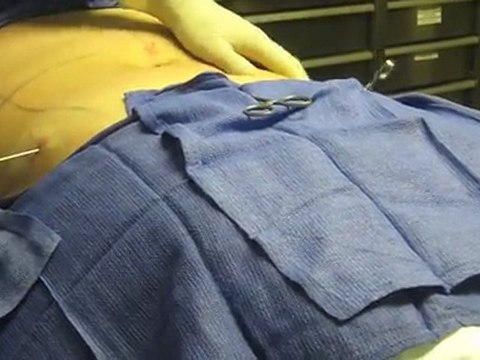 SmartLipo Laser Liposuction- Los Angeles County-Orange County-Riverside County-San Bernardino County-Inland Empire-Anaheim-Fullerton-Beverly Hills-Pasadena-Burbank-Hollywood-Cerritos-Long Beach-Irvine-Costa Mesa-Orange-Brea-Whittier-Pomona-Chino-Fontana