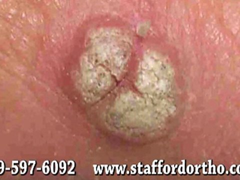 Foot Warts - Podiatrist in Manahawkin, Barnegat, Little Egg Harbor, NJ