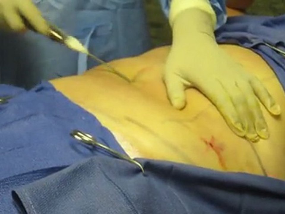 SmartLipo Laser Liposuction- Los Angeles County-Orange County-Riverside County-San Bernardino County-Inland Empire-Anaheim-Fullerton-Beverly Hills-Pasadena-Burbank-Hollywood-Cerritos-Long Beach-Irvine-Costa Mesa-Orange-Brea-Whittier-Pomona-Chino-Fontana