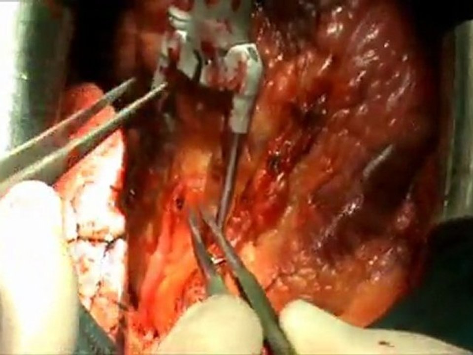 Diagonal  Bypass - Op. Dr. Mahmut Akyıldız