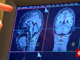 Découverte - Commotions cérébrales et dépression