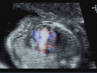 Ventricolo destro a doppia uscita