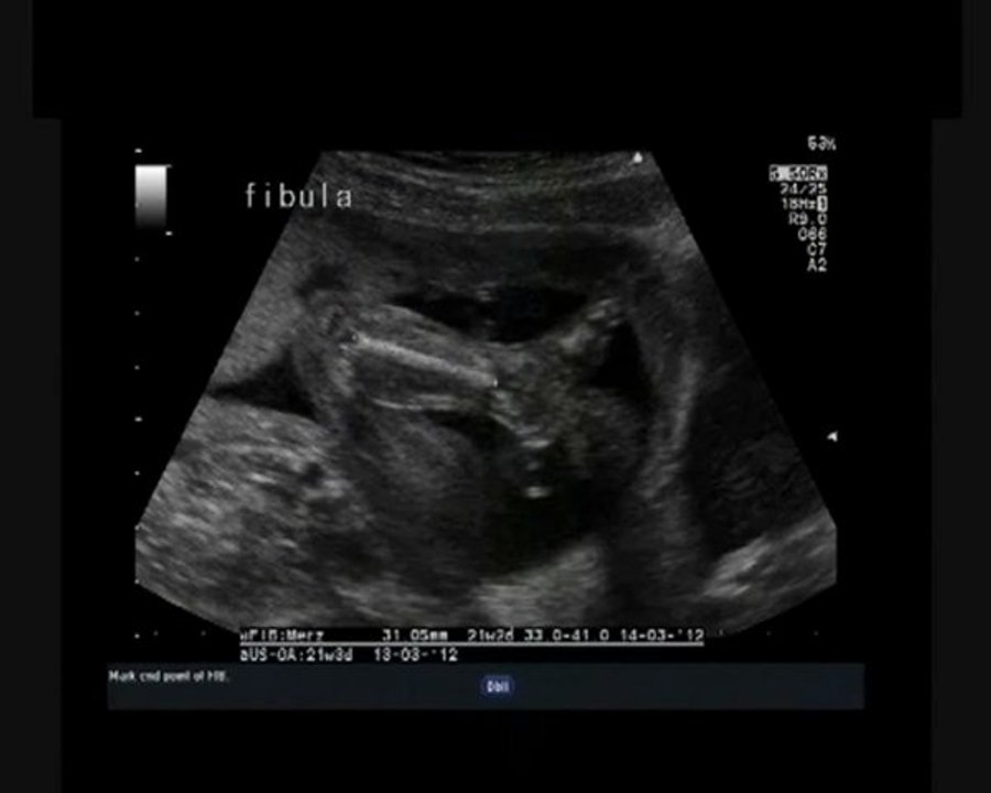 Sindrome di Seckel
