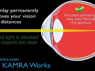 How The Kamra Inlay Corrects Presbyopia