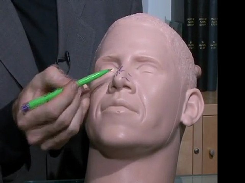 Best Rhinoplasty Nose Job Surgery in San Francisco Bay Area