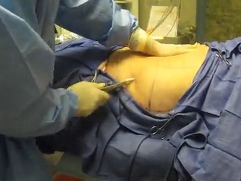 Laser Liposuction-SmartLipo-Abdomen-Flanks-Los Angeles-Orange County-Pasadena-Covina-Whittier-Rowland Heights-Chino Hills-Glendora-San Dimas-Brea-La Habra-Fullerton