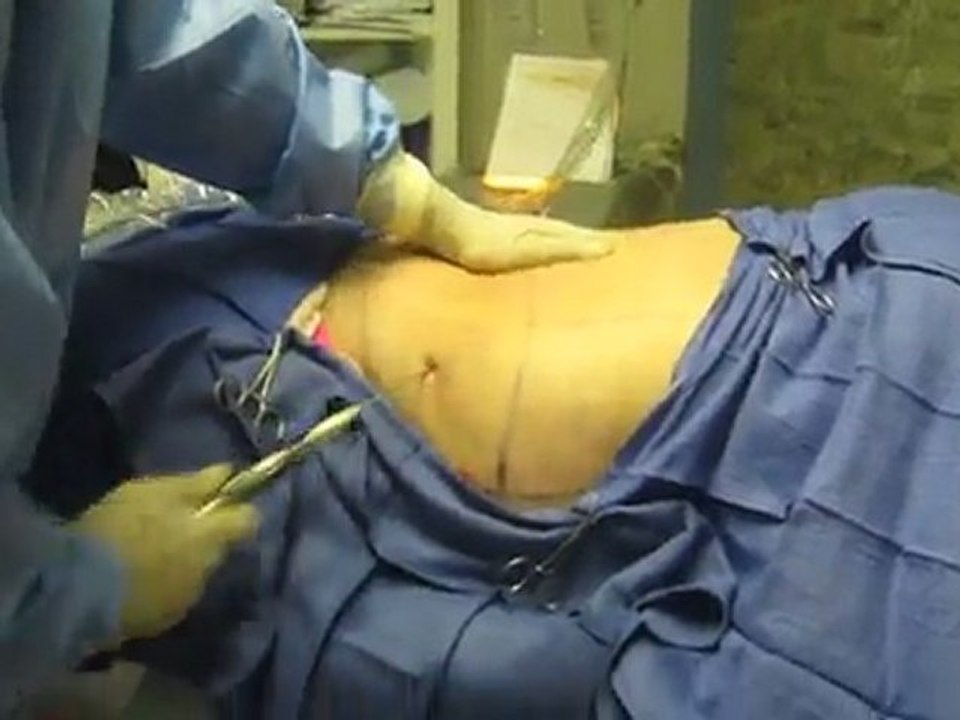 Laser Liposuction-SmartLipo-Abdomen-Flanks-Los Angeles-Orange County-Pasadena-Covina-Rowland Heights-Whittier-Brea-La Habra