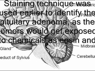 Pituitary Gland Tumor