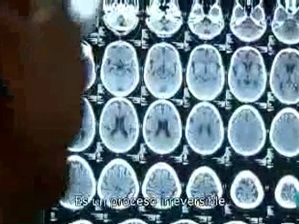 Alzheimer: Sintomas y diagnostico (R. Petersen)