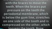 A Simple Explanation of How Braces Work