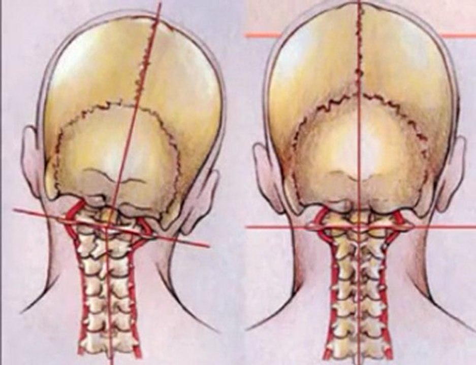 Relief Back & Neck Pain, Sciatica, Disc problems
