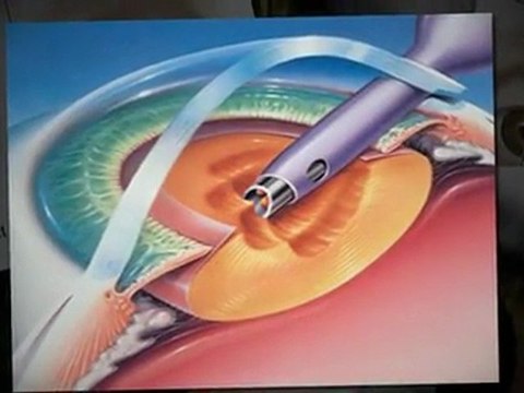 Cataract Surgery/West Springfield, MA/413-781-6352