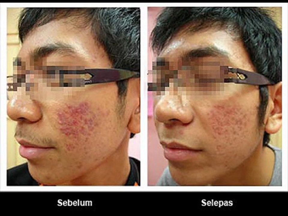 Cara Menghilangkan Jerawat Dalam 60 Hari