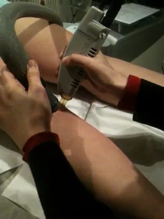 epilation définitive au laser alexandrite 2