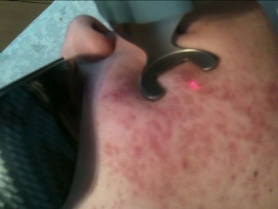 relissage resurfacing sur acné (peeling laser)