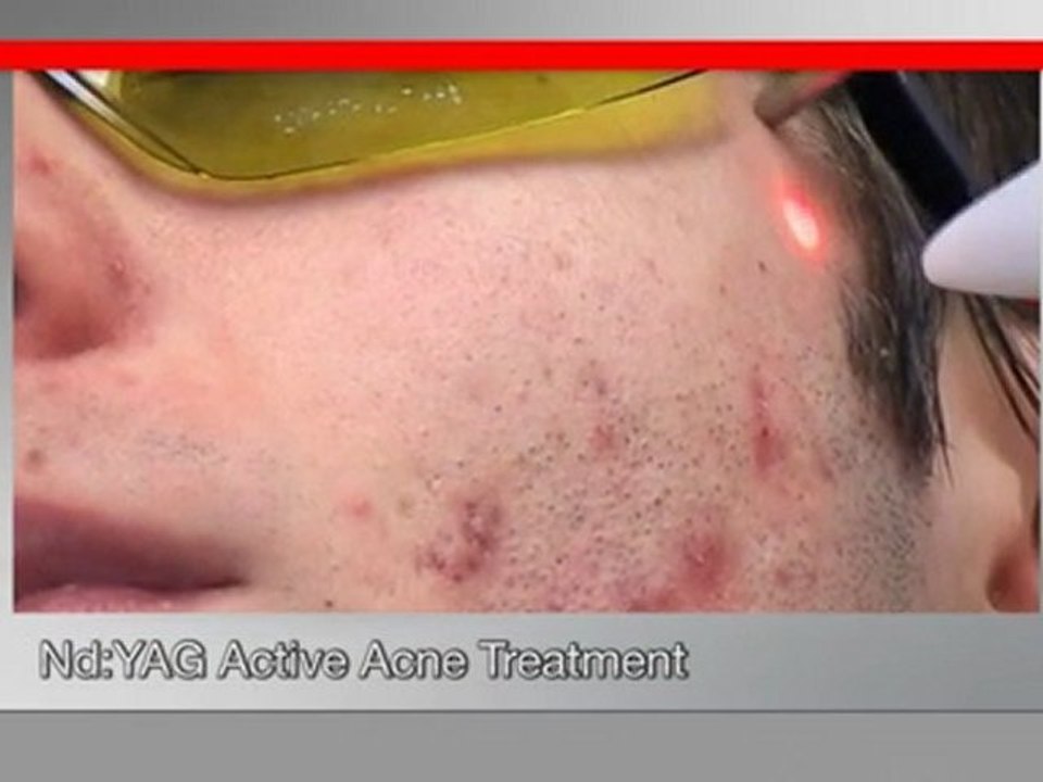 Le laser fotona, erbium et Yag