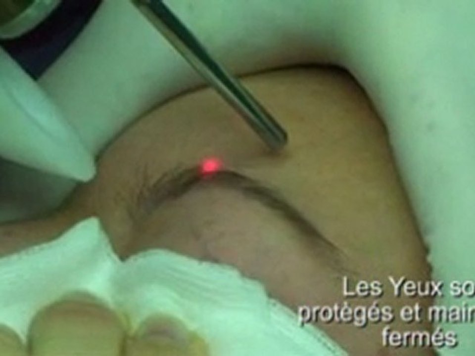 epilation definitive des sourcils au laser