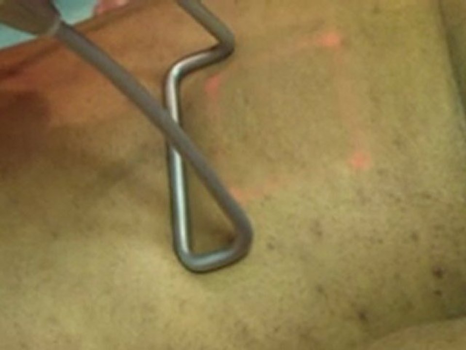 epilation laser definitive peau metisse et noire