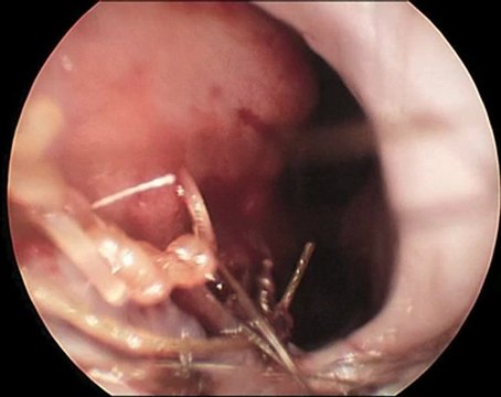 Deviated Septum Before and After Septoplasty | Seattle Septoplasty Surgeon