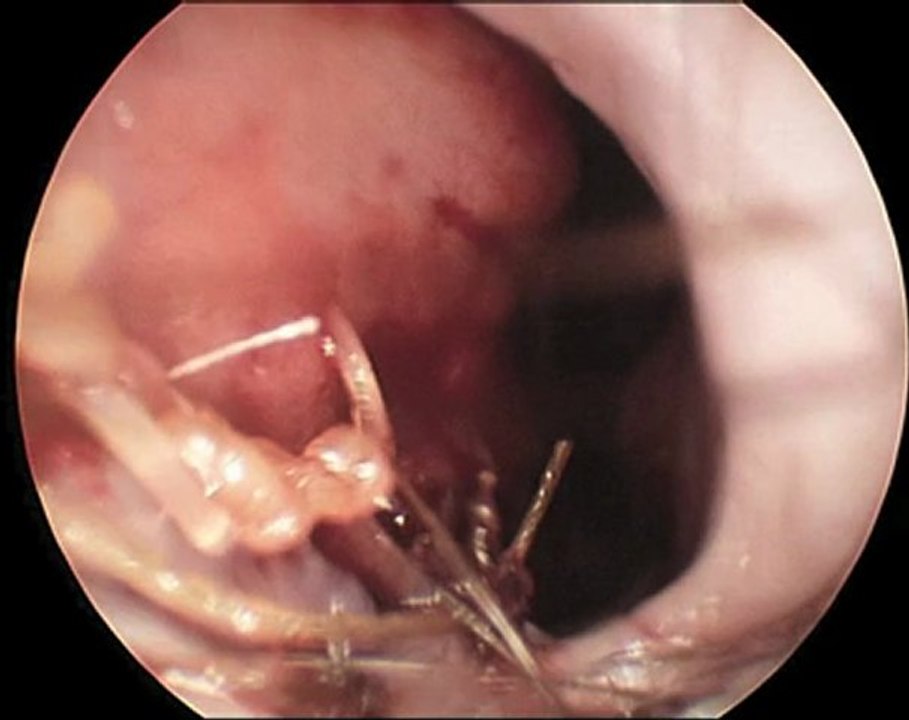Deviated Septum Before and After Septoplasty | Seattle Septoplasty Surgeon