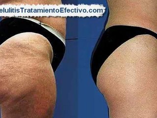 Tratamiento Contra la Celulitis [Como sacar la celulitis]