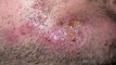 cures for ringworm - ringworm cures for humans - how to get rid of a ringworm