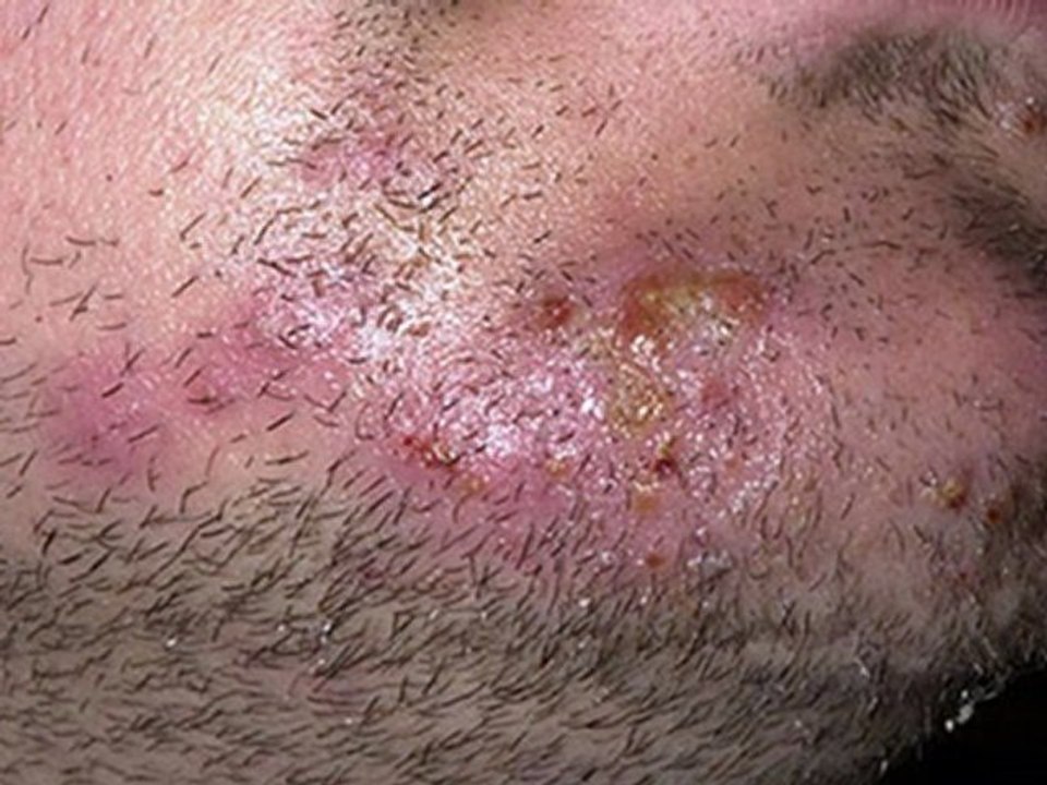 cures for ringworm - ringworm cures for humans - how to get rid of a ringworm