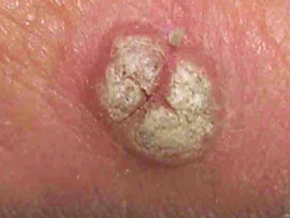 Foot Warts Treatment - Podiatrist in Frederick, Germantown and Hagerstown, MD