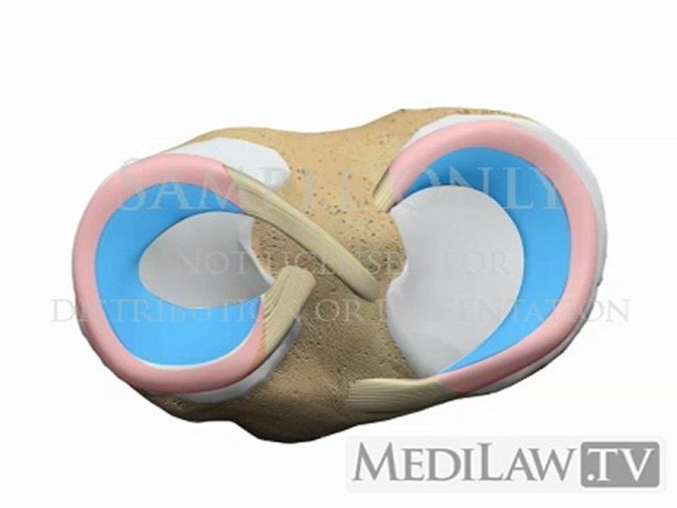 Knee Meniscal Meniscus Longitudinal Vertical Bucket Handle Tear medical trial exhibits multimedia
