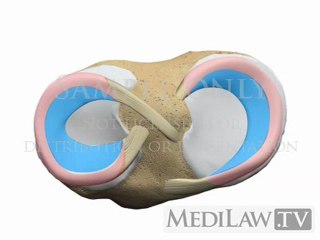 Knee Meniscal Meniscus Longitudinal Vertical Bucket Handle Tear medical trial exhibits multimedia