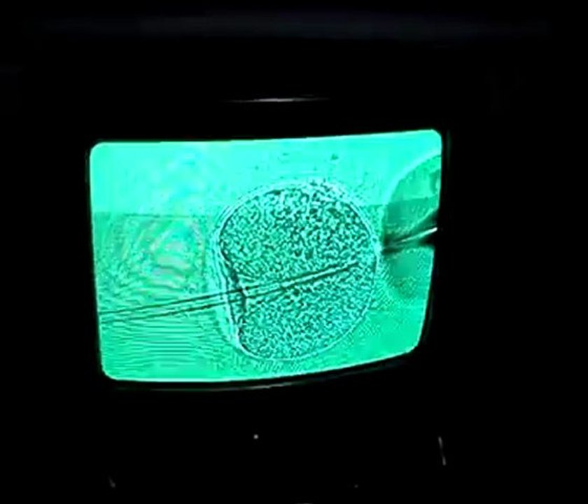 ICSI procedure- Kiran Infertility Center, Hyderabad, India - the surrogacy and Infertility Experts