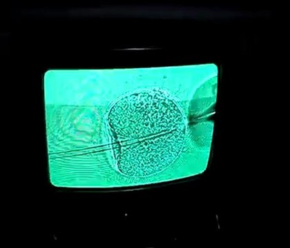 ICSI procedure- Kiran Infertility Center, Hyderabad, India - the surrogacy and Infertility Experts