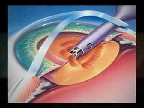 Cataract Surgery in New England 413-781-6352