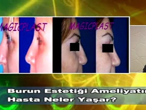 Dr. Güner Uysal Burun Ameliyatı Sonrası