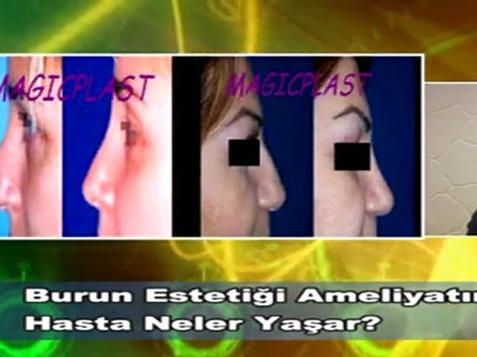 Dr. Güner Uysal Burun Ameliyatı Sonrası