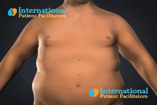 Obesity Surgery,Lap Band,in Tijuana,Mexico by Sheri Burke